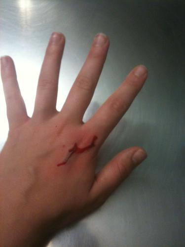 I pranged my hand for TTTs